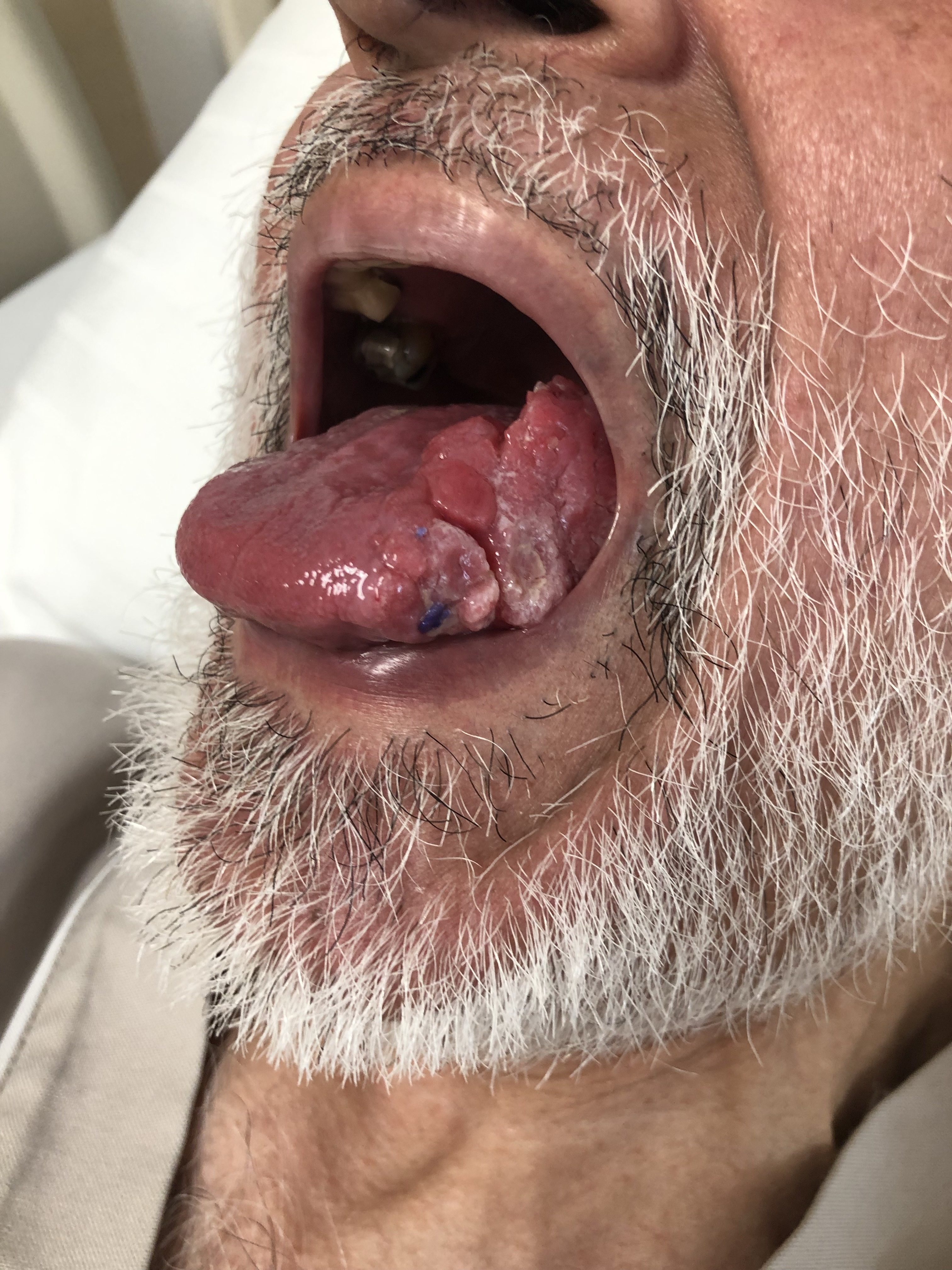 tongue cancer pictures
