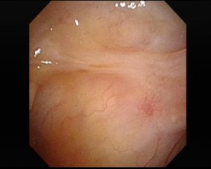 Sinusitis Ncbi