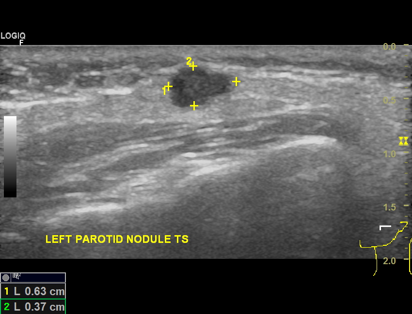 parotid gland tumor ultrasound