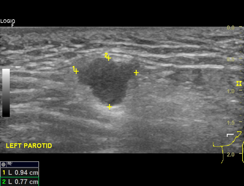 parotid gland tumor ultrasound