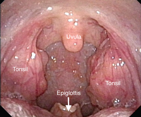 Sinus drainage in throat tonsils adults