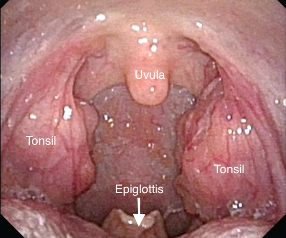 Aspiration #caséum #amygdale, #Tonsil #stone removal. Dr Danvin JB #me