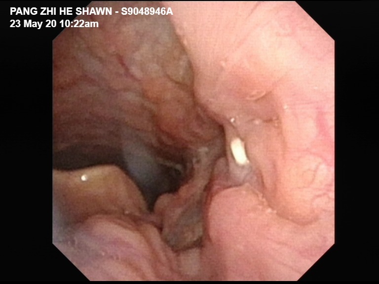 tonsil stone removal