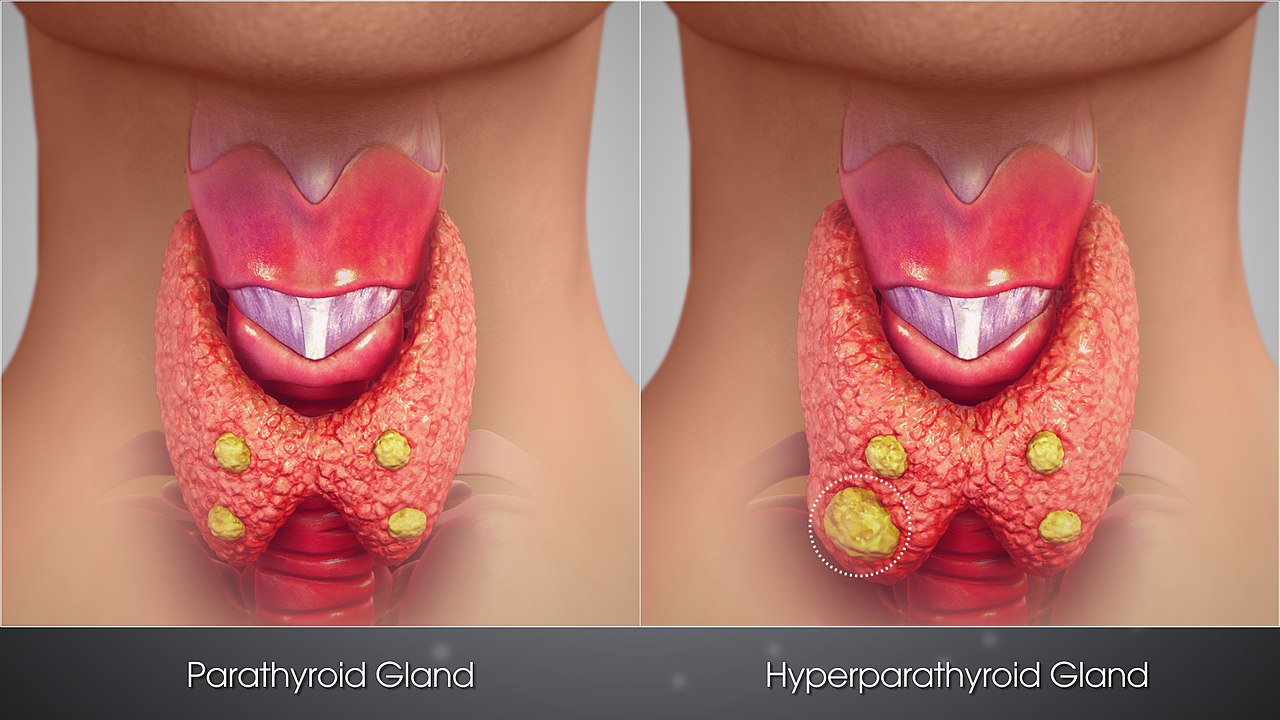 Parathyroid, parathyroid surgery, parathyroidectomy, calcium,  hypercalcaemia | Dr Jeeve ENT Specialist