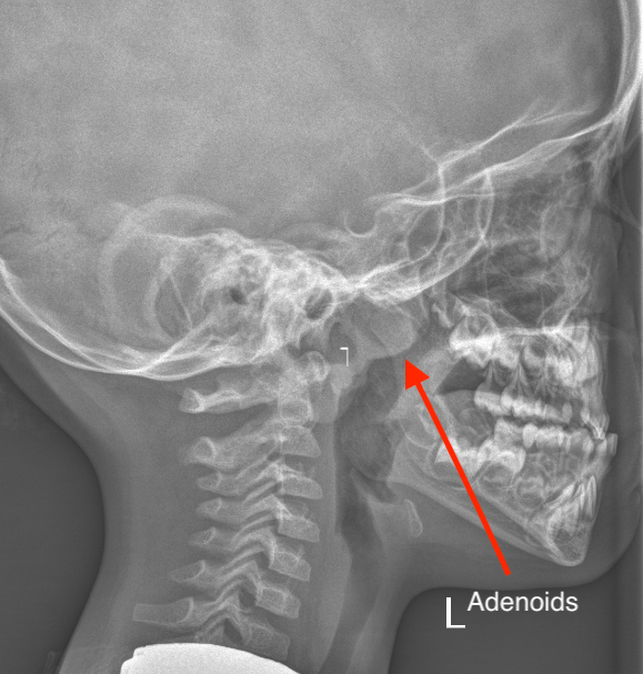 Adenoids Xray