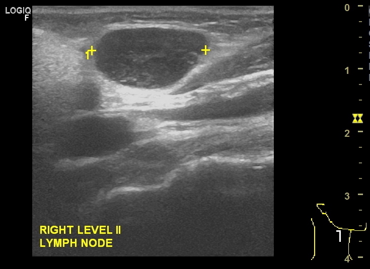 Swollen Lymph Nodes In The Neck Dr Jeeve Ent Specialist