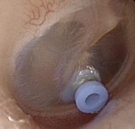 Ventilation tubes (grommets) for otitis media with effusion (OME